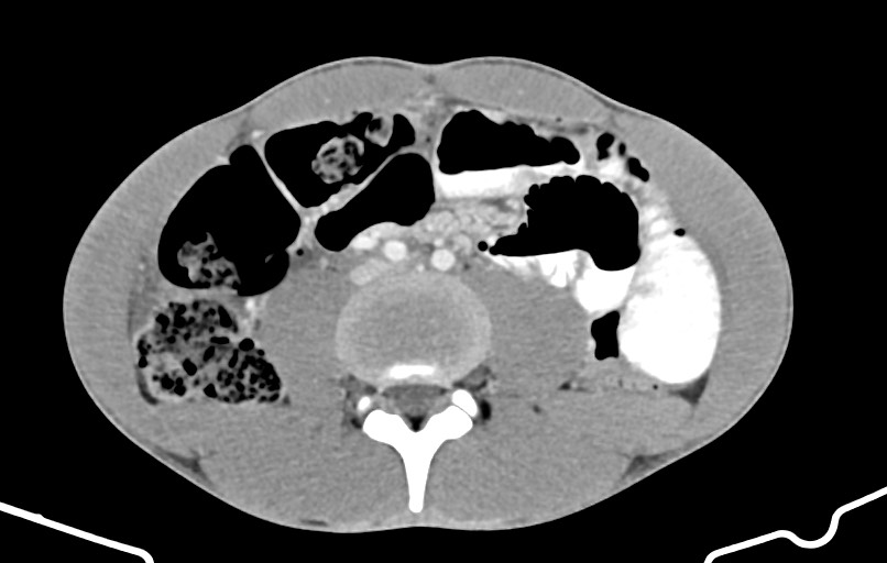 Blunt injury to the small bowel (Radiopaedia 74953-85987 A 107).jpg