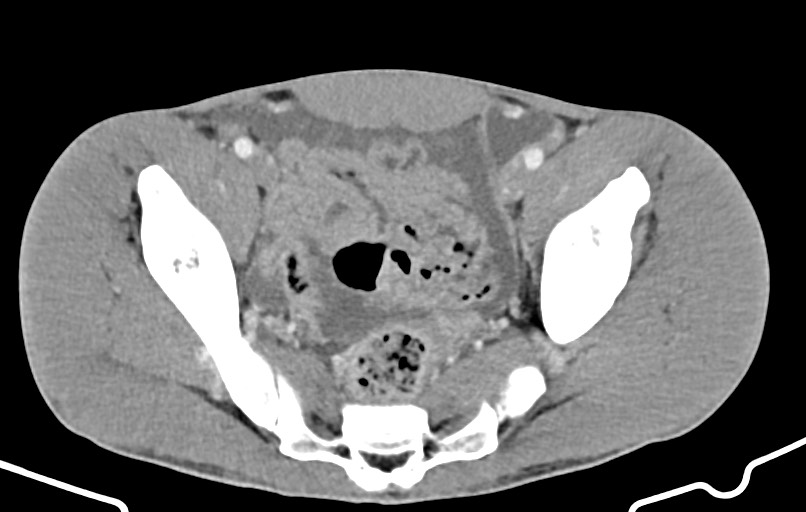 Blunt injury to the small bowel (Radiopaedia 74953-85987 A 165).jpg