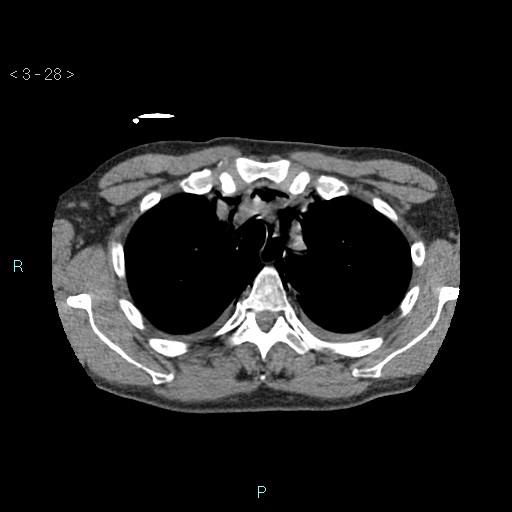 Boerhaave syndrome (Radiopaedia 27683-27897 oral contrast 28).jpg