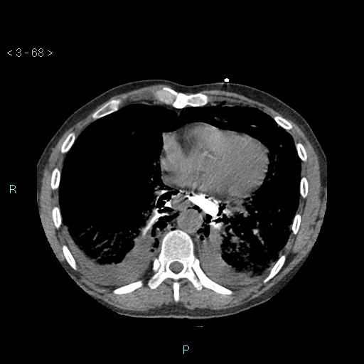 Boerhaave syndrome (Radiopaedia 27683-27897 oral contrast 68).jpg