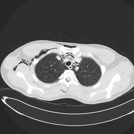 File:Boerhaave syndrome with mediastinal, axillary, neck and epidural free gas (Radiopaedia 41297-44115 Axial lung window 34).jpg