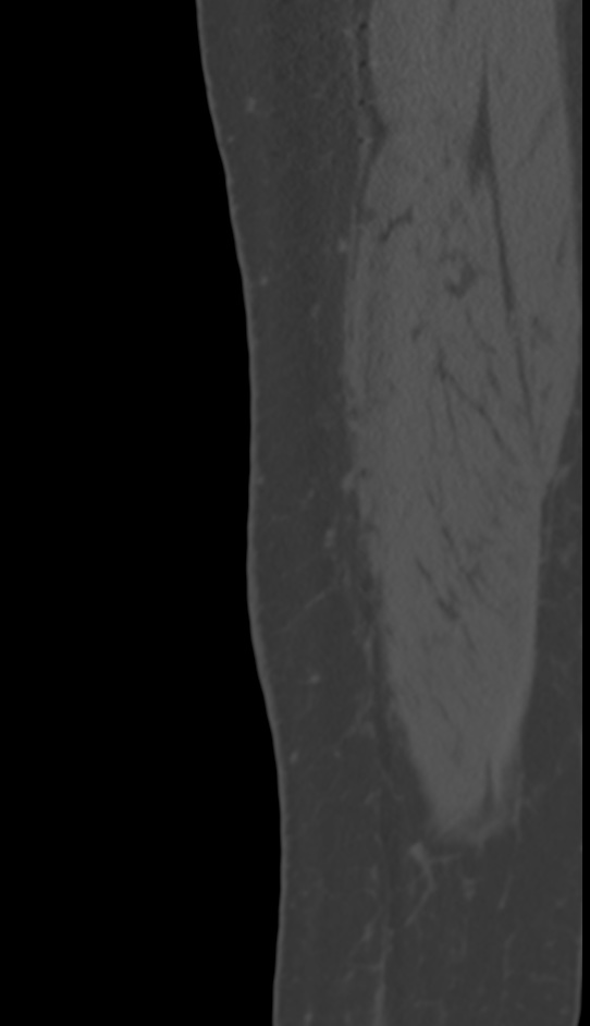 Bone metastasis - tibia (Radiopaedia 57665-64609 Sagittal bone window 7).jpg