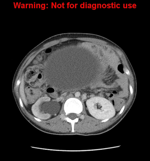 Borderline mucinous cystadenoma of ovary (Radiopaedia 25586-25767 A 8).jpg