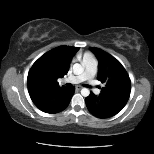 File:Borderline mucinous tumor (ovary) (Radiopaedia 78228-90808 A 21).jpg
