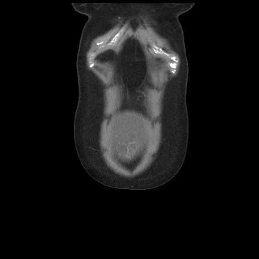 Borderline mucinous tumor (ovary) (Radiopaedia 78228-90808 C 8).jpg