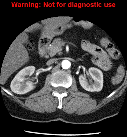 File:Bosniak renal cyst - type II (Radiopaedia 23404-23468 B 19).jpg