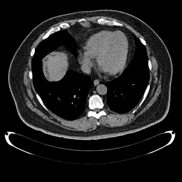 Bosniak renal cyst - type IV (Radiopaedia 24244-24518 Axial non-contrast 8).jpg