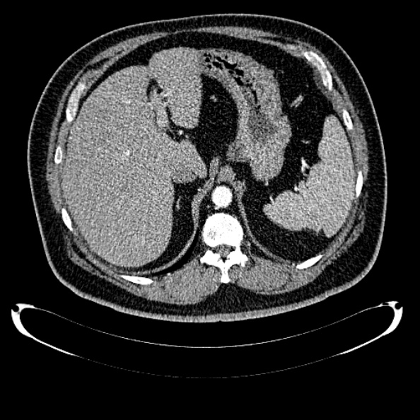 Bosniak renal cyst - type IV (Radiopaedia 24244-24518 B 66).jpg