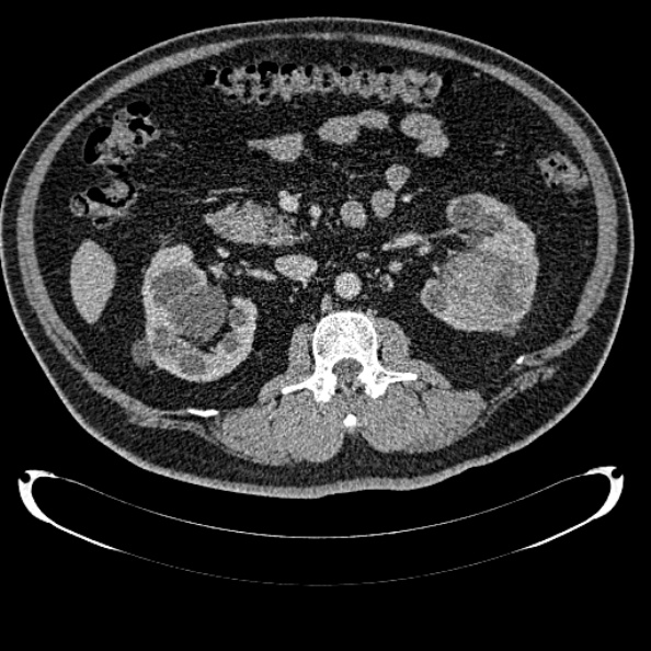 Bosniak renal cyst - type IV (Radiopaedia 24244-24518 C 150).jpg