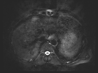 File:Bouveret syndrome (Radiopaedia 61017-68856 Axial MRCP 8).jpg