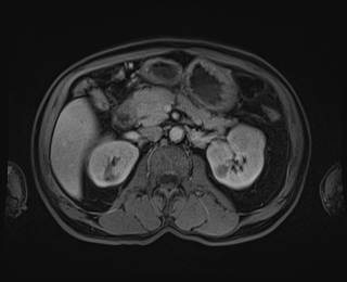 Bouveret syndrome (Radiopaedia 61017-68856 Axial T1 C+ fat sat 40).jpg
