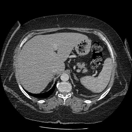 Bovine aortic arch - right internal mammary vein drains into the superior vena cava (Radiopaedia 63296-71875 A 165).jpg