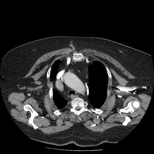 Bovine aortic arch - right internal mammary vein drains into the superior vena cava (Radiopaedia 63296-71875 A 29).jpg