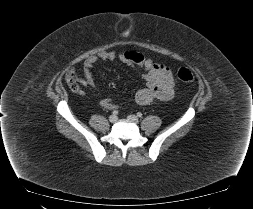 File:Bowel and splenic infarcts in acute lymphocytic leukemia (Radiopaedia 61055-68913 A 89).jpg