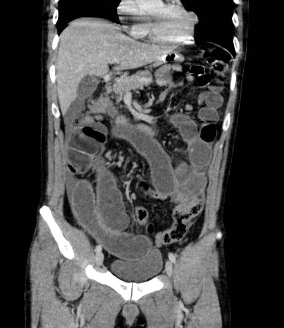 Bowel obstruction from colon carcinoma (Radiopaedia 22995-23028 C 27).jpg