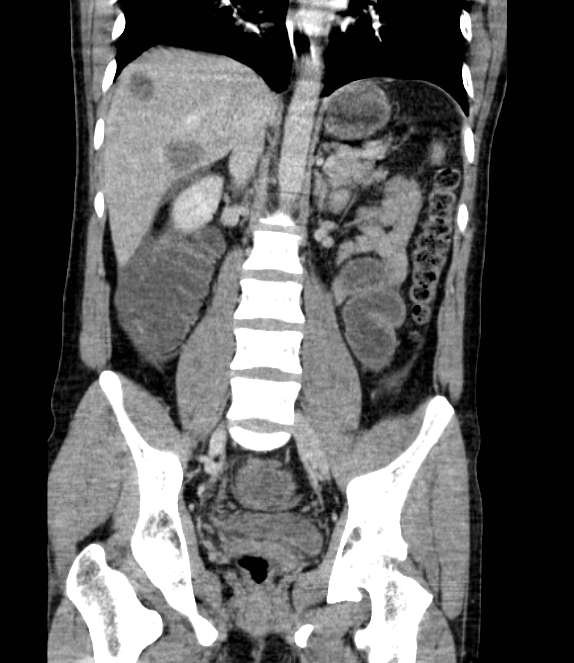 Bowel obstruction from colon carcinoma (Radiopaedia 22995-23028 C 45).jpg
