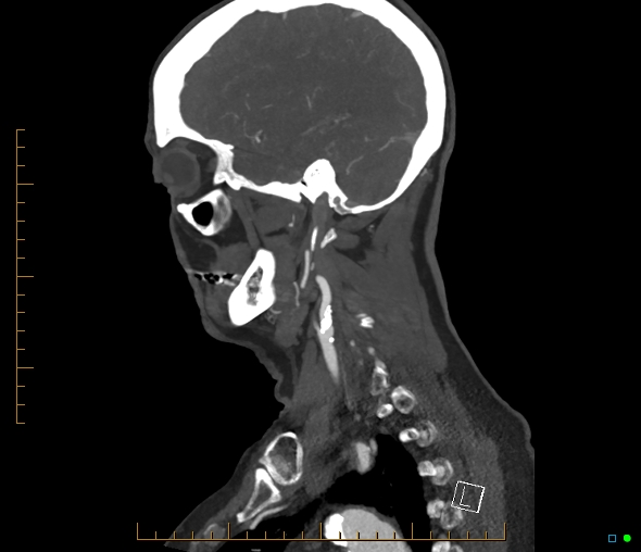 Brachiocephalic trunk stenosis (Radiopaedia 87242-103519 C 18).jpg