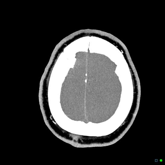 Brain death on MRI and CT angiography (Radiopaedia 42560-45841 B 9).jpg