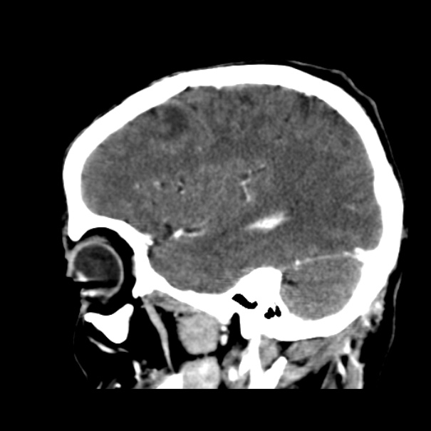 Brain metastases from lung cancer (Radiopaedia 24480-24781 C+ delayed 43).jpg
