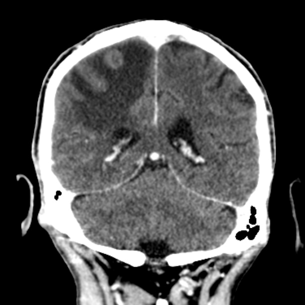 Brain metastases from lung cancer (Radiopaedia 27849-28092 Coronal C+ delayed 46).jpg