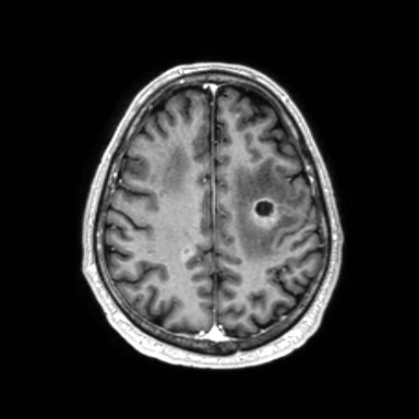 File:Brain metastases from lung cancer (Radiopaedia 83839-99028 Axial T1 C+ 49).jpg