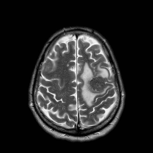 File:Brain metastases from lung cancer (Radiopaedia 83839-99028 Axial T2 28).jpg