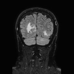 Brain metastases from lung cancer (Radiopaedia 83839-99028 Coronal FLAIR 69).jpg