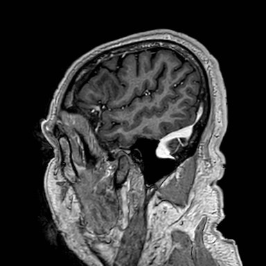 Brain metastases from lung cancer (Radiopaedia 83839-99028 Sagittal T1 C+ 8).jpg