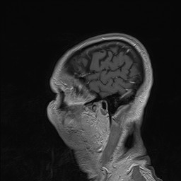 Brain metastasis (Radiopaedia 42617-45761 Sagittal T1 C+ 86).jpg