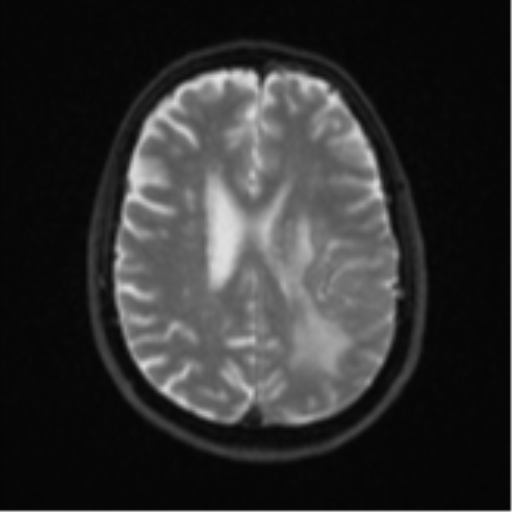 Brain metastasis (large cystic mass) (Radiopaedia 47497-52107 Axial DWI 18).png