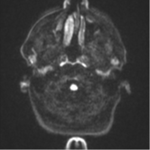 Brain metastasis (large cystic mass) (Radiopaedia 47497-52107 Axial DWI 29).png