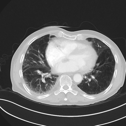 File:Brain metastasis (lung cancer) (Radiopaedia 48289-53180 Axial lung window 40).png