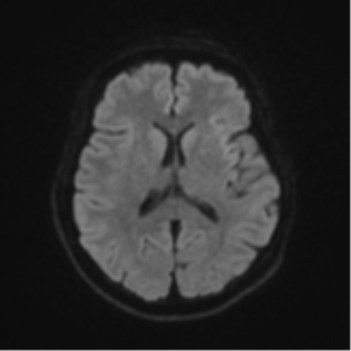 Brain metastasis (sarcoma) (Radiopaedia 47576-52209 Axial DWI 43).png