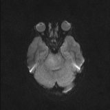 Brainstem glioma (Radiopaedia 67531-76922 Axial DWI 32).jpg