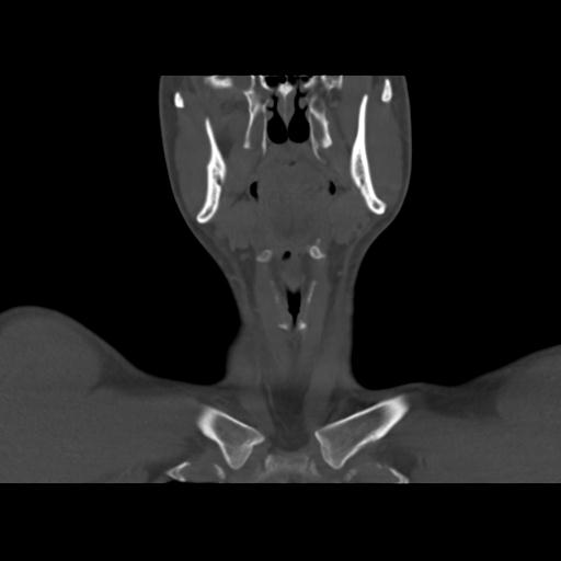 Branchial cleft cyst (Radiopaedia 31167-31875 Axial bone window 1).jpg
