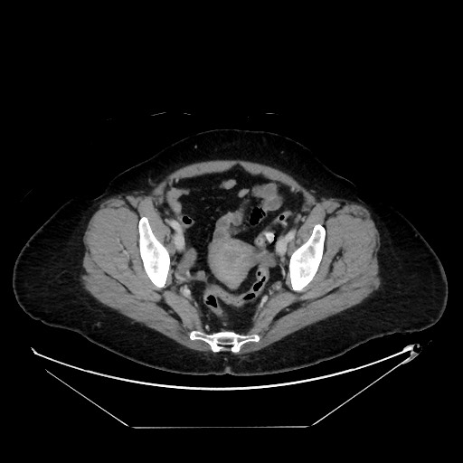 File:Breast cancer pseudocirrhosis with lobar invovlement (Radiopaedia 81080-94670 A 136).jpg