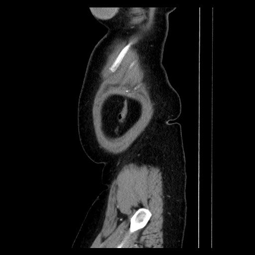 Breast cancer pseudocirrhosis with lobar invovlement (Radiopaedia 81080-94670 D 188).jpg