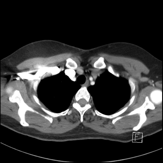 File:Breast metastases from renal cell cancer (Radiopaedia 79220-92225 A 17).jpg