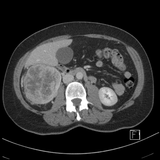 Breast metastases from renal cell cancer (Radiopaedia 79220-92225 C 47).jpg