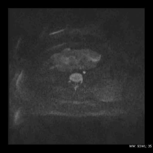 File:Broad ligament fibroid (Radiopaedia 49135-54241 Axial DWI 6).jpg