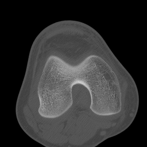 Brodie abscess of the tibia (Radiopaedia 58984-66250 Axial bone window 46).jpg