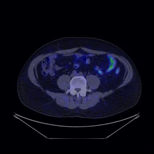 Bronchial carcinoid tumor (Radiopaedia 67377-76765 68Ga-DOTATATE PET-CT 59).jpg
