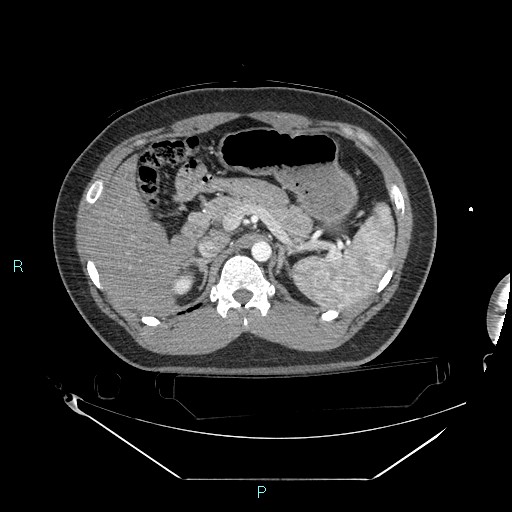 Bronchial carcinoid tumor (Radiopaedia 78272-90870 B 127).jpg