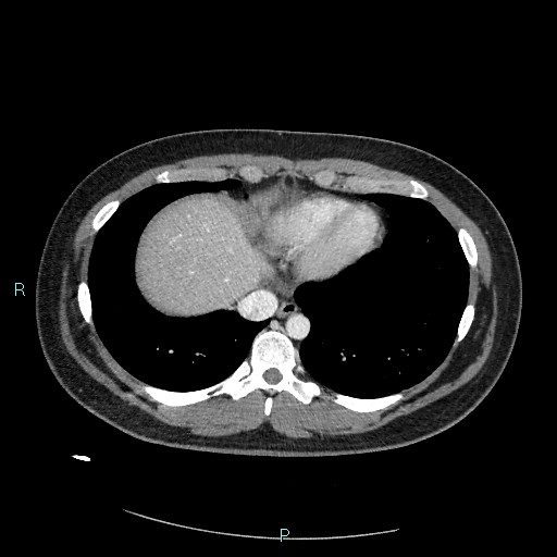 Bronchial carcinoid tumor (Radiopaedia 78272-90875 A 74).jpg