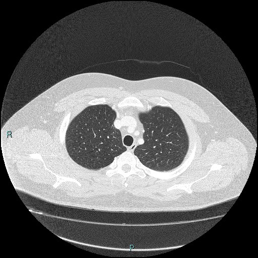 Bronchial carcinoid tumor (Radiopaedia 78272-90875 Axial lung window 9).jpg
