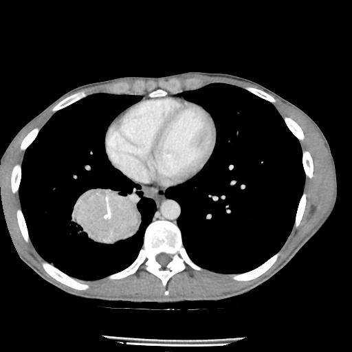 Bronchial carcinoid tumor causing right lower lobe collapse (Radiopaedia 83495-98594 A 35).jpg