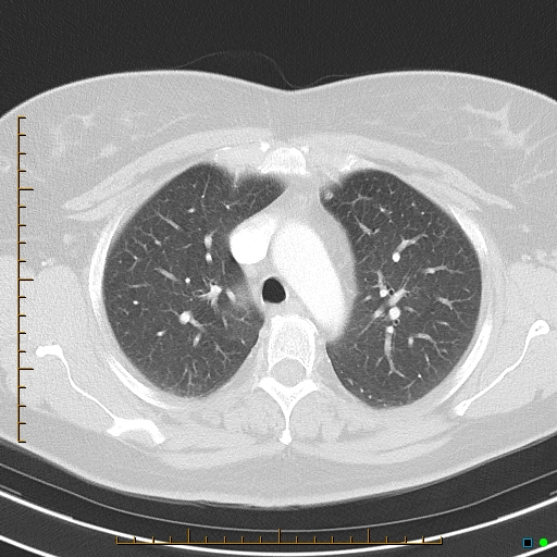 Bronchial diverticula (Radiopaedia 79512-92675 Axial lung window 15).jpg