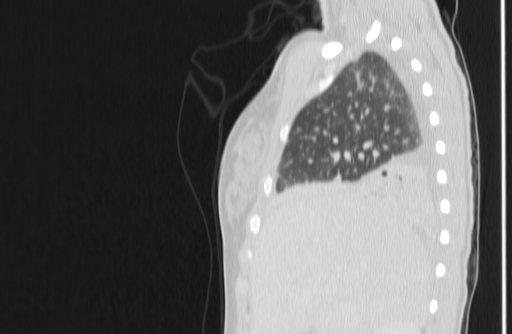Bronchial mucoepidermoid carcinoma (Radiopaedia 57023-63895 Sagittal lung window 11).jpg
