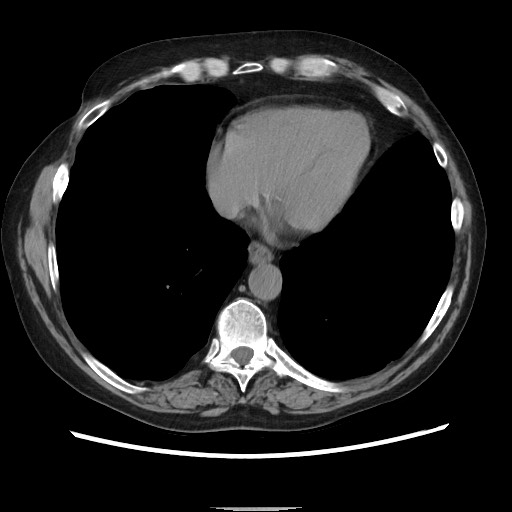 Bronchial stenosis - lung transplant (Radiopaedia 73133-83848 Axial non-contrast 45).jpg