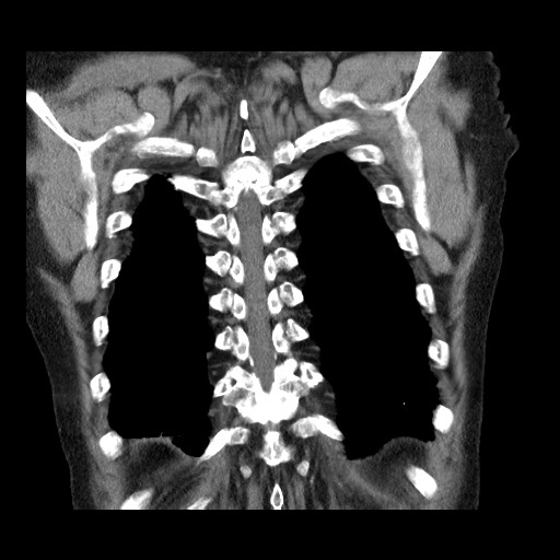Bronchial stenosis - lung transplant (Radiopaedia 73133-83848 Coronal non-contrast 54).jpg